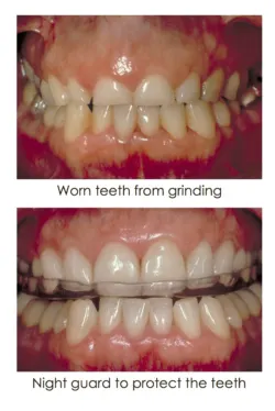 Teeth Grinding Treatment